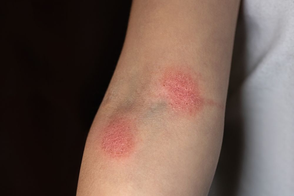 New Advances in Mycosis Fungoides Treatment