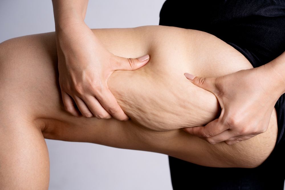 Cellulite Treatments That Work and That Don’t