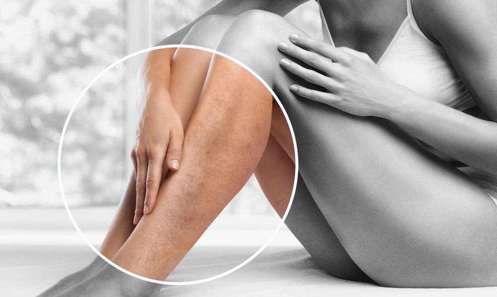 Sclerotherapy: Here's the Secret to Smooth, Vein-Free Legs