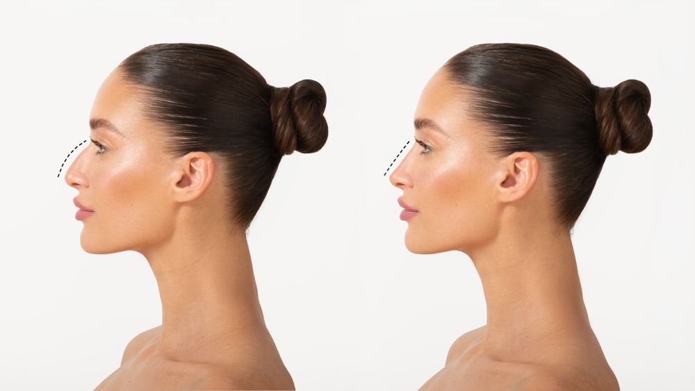 Transform Your Confidence Today With Rhinoplasty