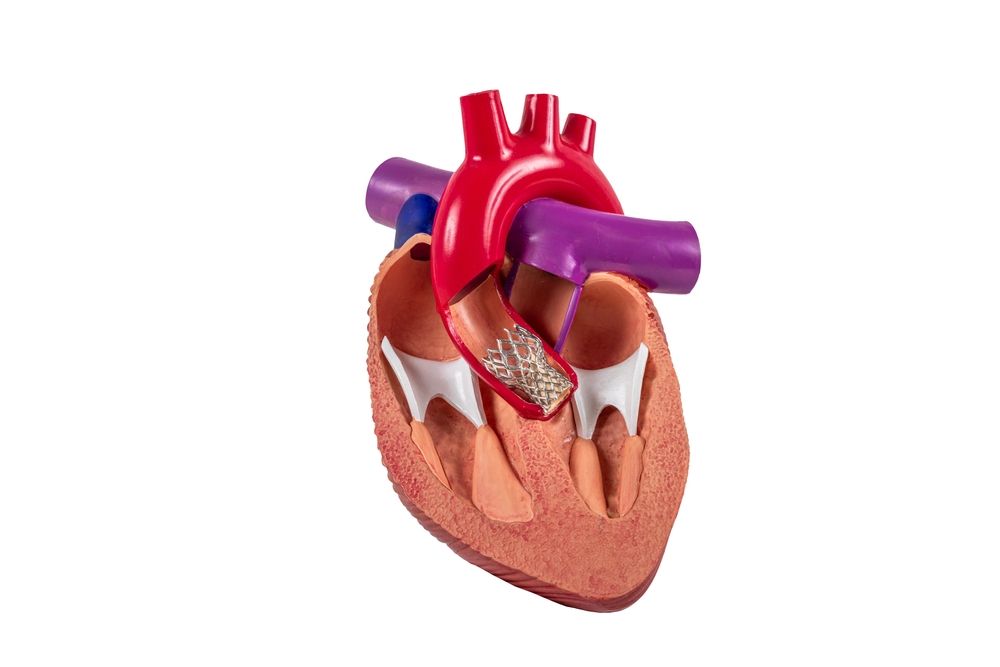 Things to Know About Aortic Valve Surgery