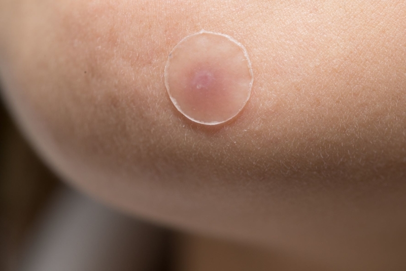 Pimple Patches | Shutterstock