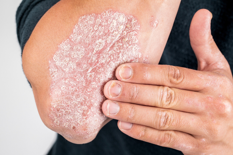 Alivio de psoriasis y eczemas | Shutterstock Photo by Fuss Sergey
